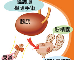 攝護腺癌的放射治療引起陽痿，使用威而鋼是否有效？